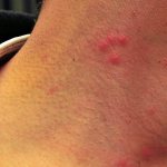 15 most effective ointments for bedbug bites: how and what to treat (smear) a person with bed bugs