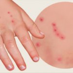 Paths of bedbug bites in children