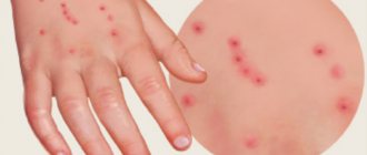 Paths of bedbug bites in children