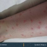 Photo of bites on human skin