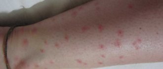 Photo of bites on human skin