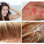 Can lice appear on nerves?