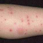 Bedbug bites